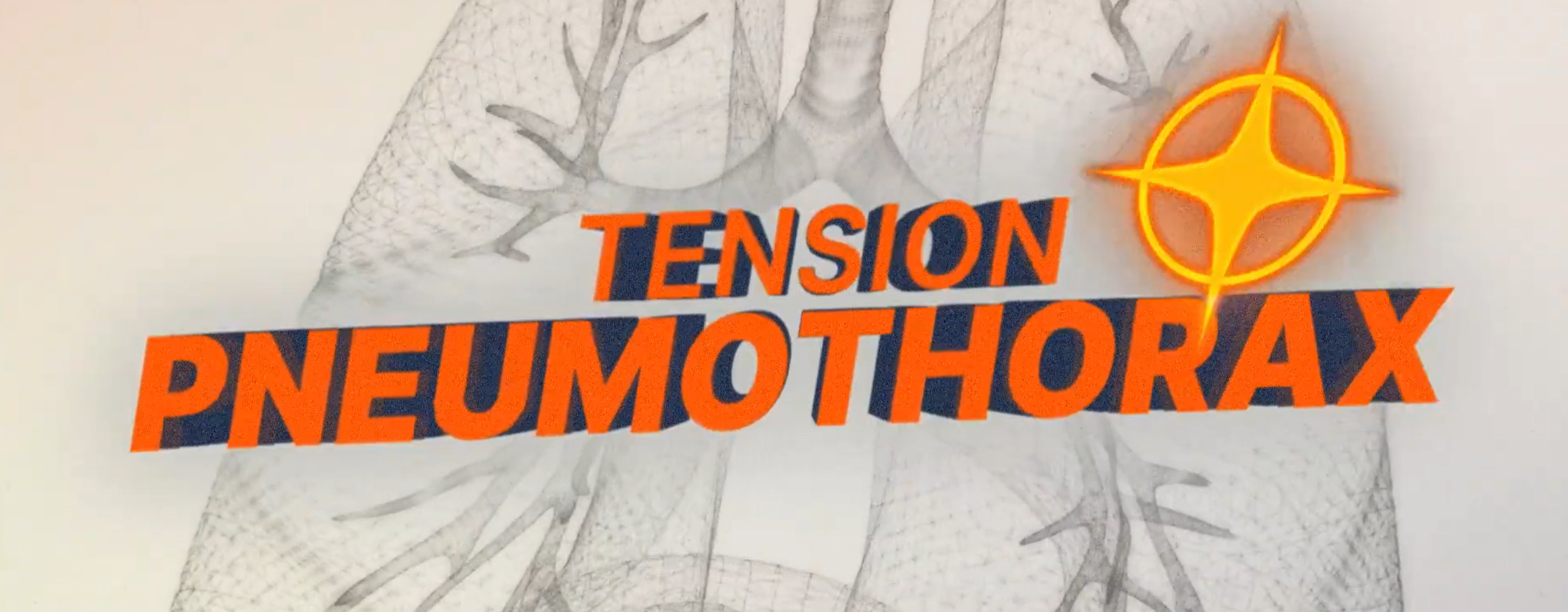 Pneumothorax